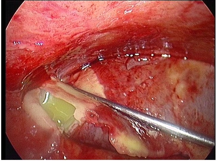 imagini abces hepatic